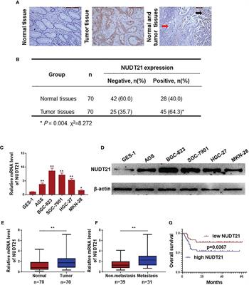 NUDT21 Promotes Tumor Growth and Metastasis Through Modulating SGPP2 in Human Gastric Cancer